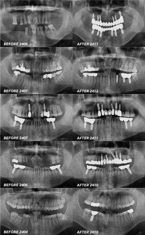 오스템임플란트 등급 종류 어떤 기준으로 나뉠까요 관련 이미지 6