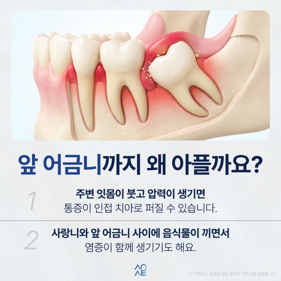 매복사랑니 통증 주위염 때문에 그럴 수도 있을까요? 관련 이미지 4