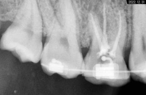 돌출입 및 신경치료와 임플란트 식립 동시 진행 증례 관련 이미지 11