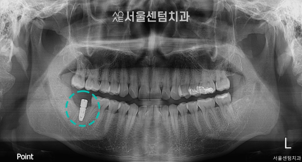 A Successful Molar Implant Case in a Patient in Their 20s image 7