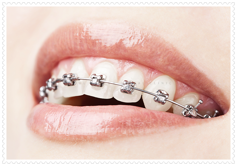 교정치료 중 주의사항 기억해두고 실천하면 좋아요 관련 이미지 2