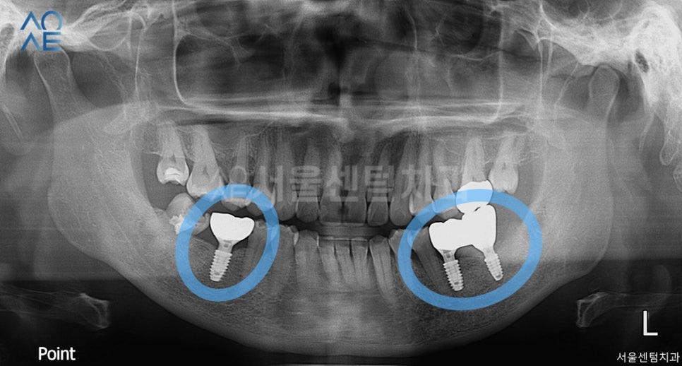 치아상실 후 임플란트 하려면 관련 이미지 4