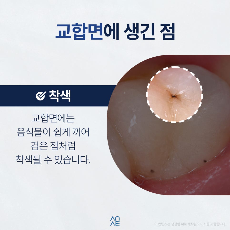 치아 검은점 발견했다면 충치인지 다른 문제인지 구분 방법 관련 이미지 2