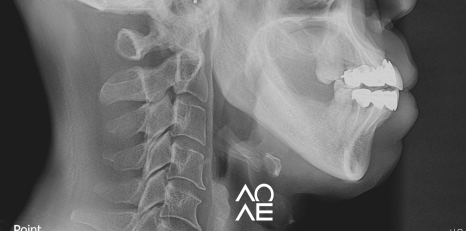 잠원동 교정 반대교합 크라운 치료도 가능합니다. 관련 이미지 9