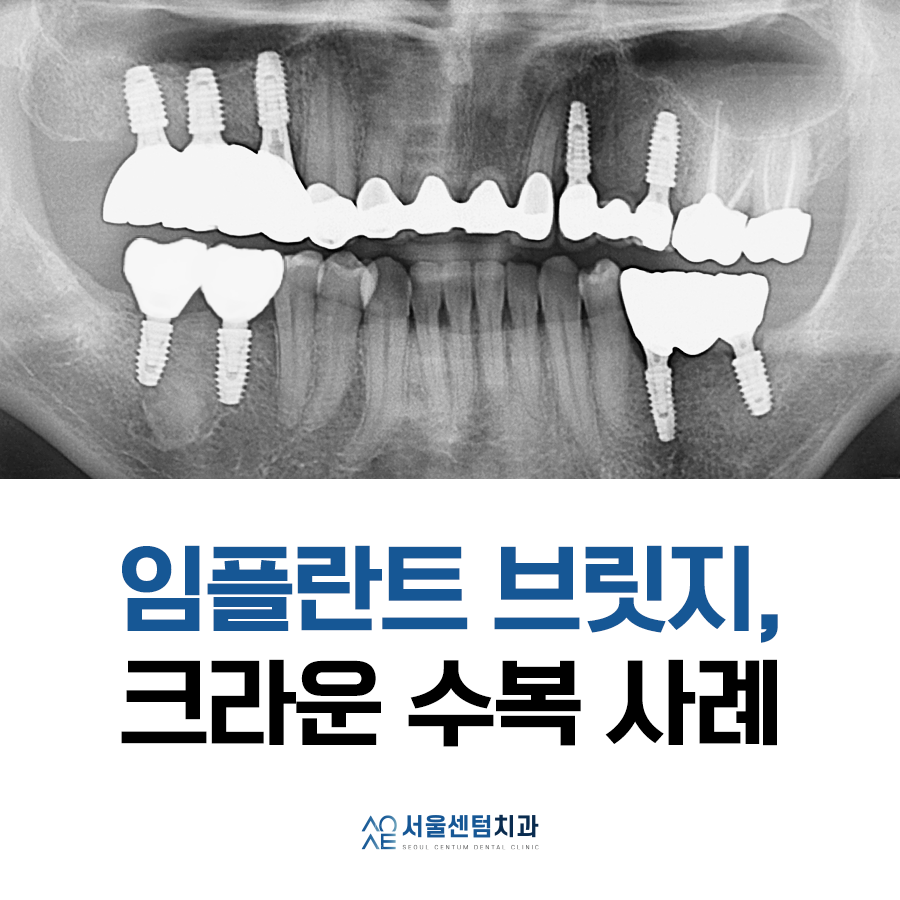 임플란트 브릿지와 크라운 수복으로 치아 기능을 회복시킨 증례 관련 이미지 1