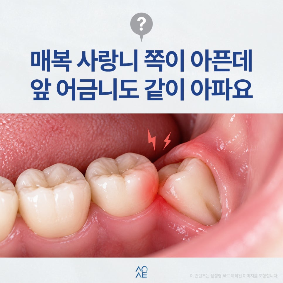 매복사랑니 통증 주위염 때문에 그럴 수도 있을까요? 관련 이미지 1