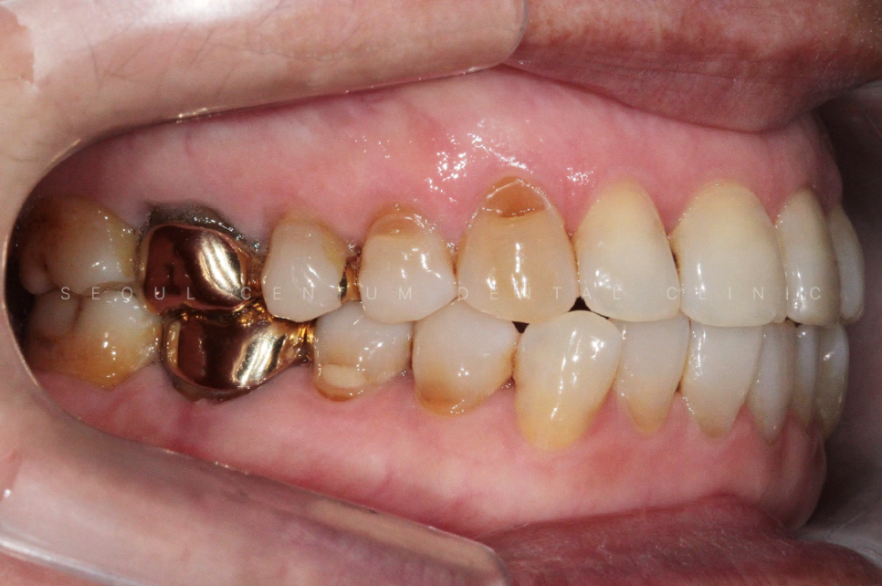 치경부마모증 가격 gi 레진 갈색치아 원인 통증 관련 이미지 10