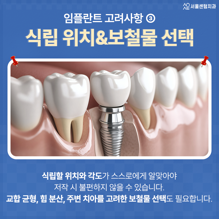 치과 임플란트 근심 걱정 놓기 위한 고려 사항 4가지 관련 이미지 4