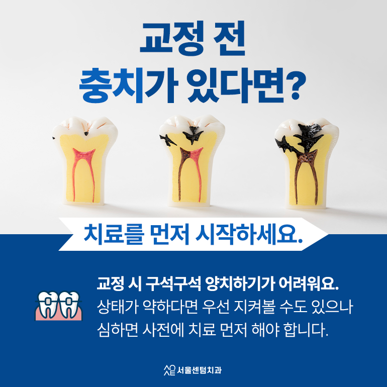 성인 치아교정 기간 평균과 단축하려면 어떻게 해야 할까 관련 이미지 2