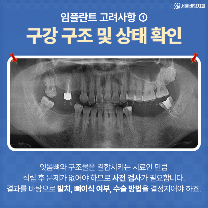 치과 임플란트 근심 걱정 놓기 위한 고려 사항 4가지 관련 이미지 2