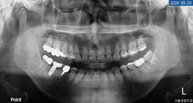 라미네이트전후 치아의 가지런한 정도와 밝기 차이 확인하기 관련 이미지 4