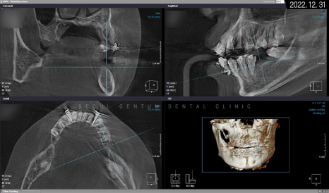 돌출입 및 신경치료와 임플란트 식립 동시 진행 증례 관련 이미지 18