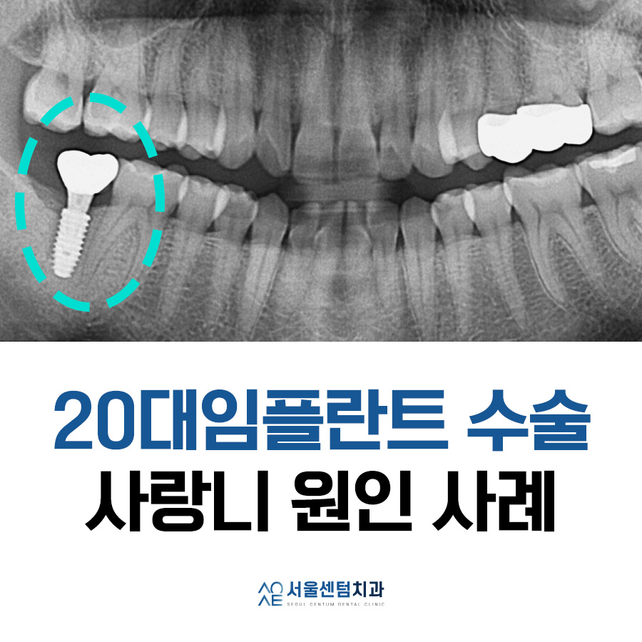 A Successful Molar Implant Case in a Patient in Their 20s image 1