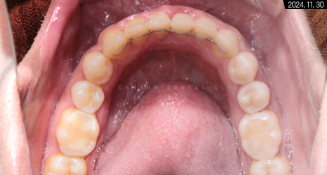 비발치로 돌출입 해소한 증례 관련 이미지 15