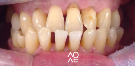 잠원동 교정 반대교합 크라운 치료도 가능합니다. 관련 이미지 12