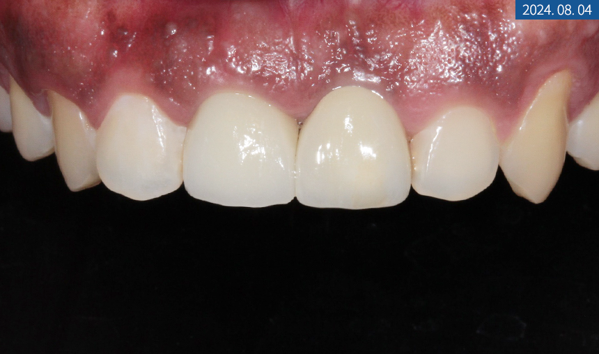 앞니 임플란트 식립으로 저작 기능을 끌어올린 증례 관련 이미지 17