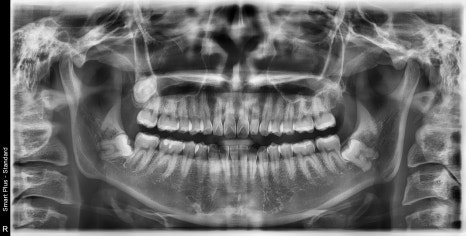 신사역 매복 사랑니 4개 발치 꼭 해야하나요? 관련 이미지 8