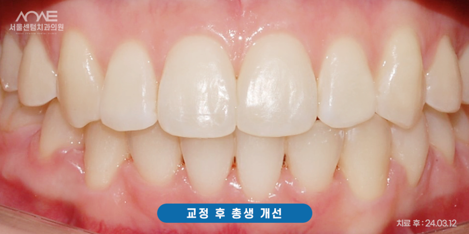 총생 앞니 덧니 발치 후 치아교정? 관련 이미지 9