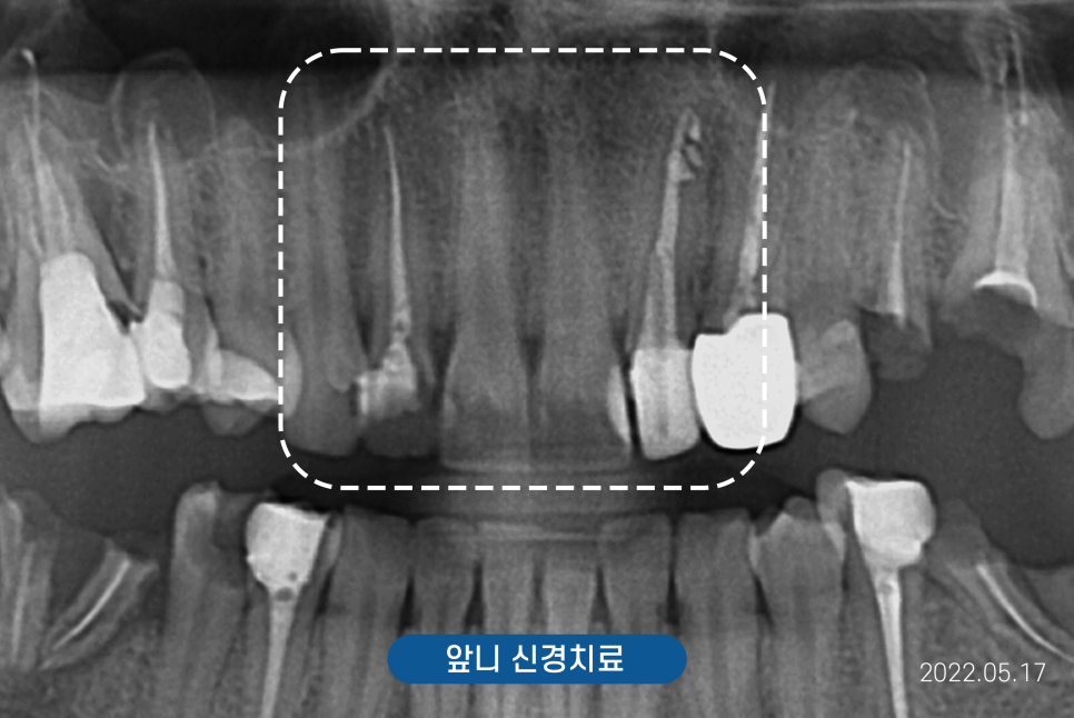 치과 앞니 사이 레진, 당일 진료 가능 관련 이미지 10