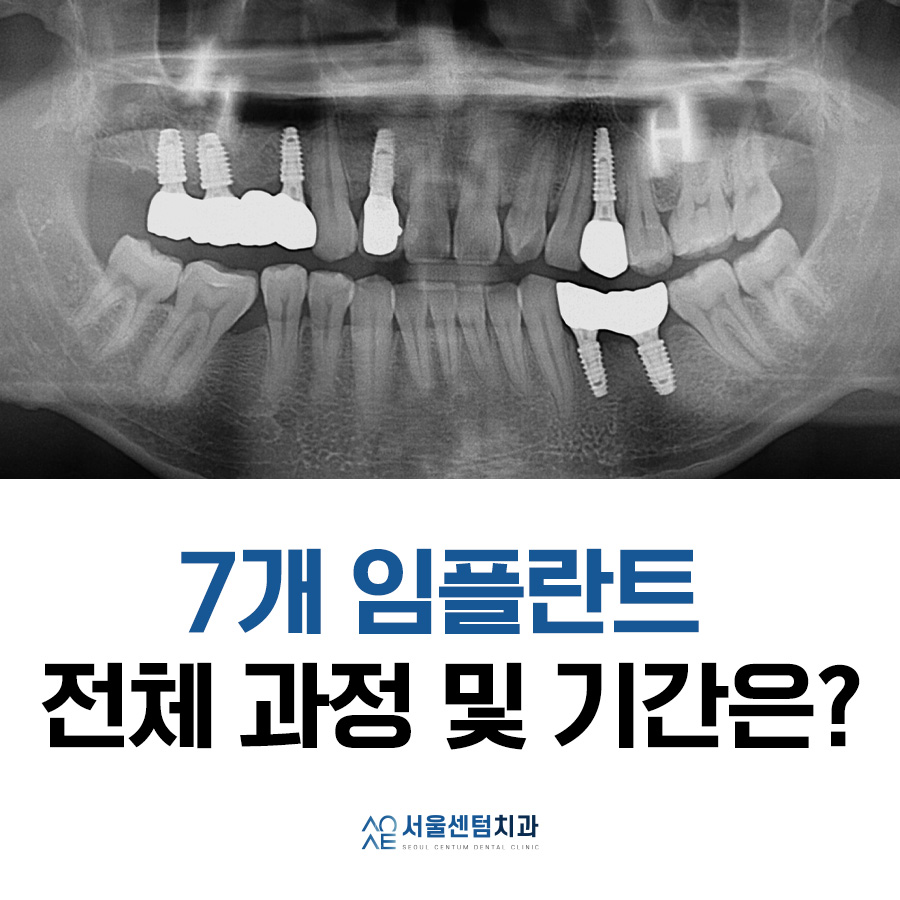 임플란트 과정 기간 실제 사례로 설명드려요 관련 이미지 8