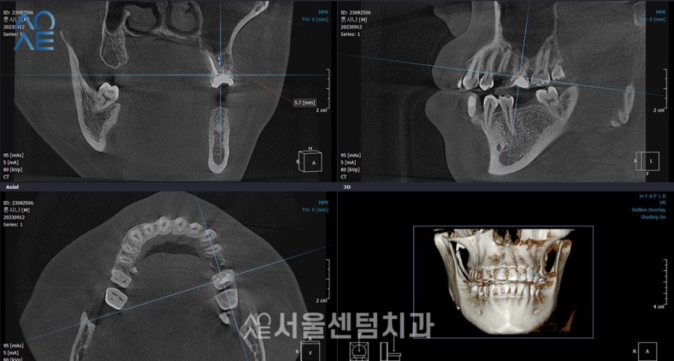 상악동수술 동반한 임플란트 진행한 이야기 관련 이미지 2