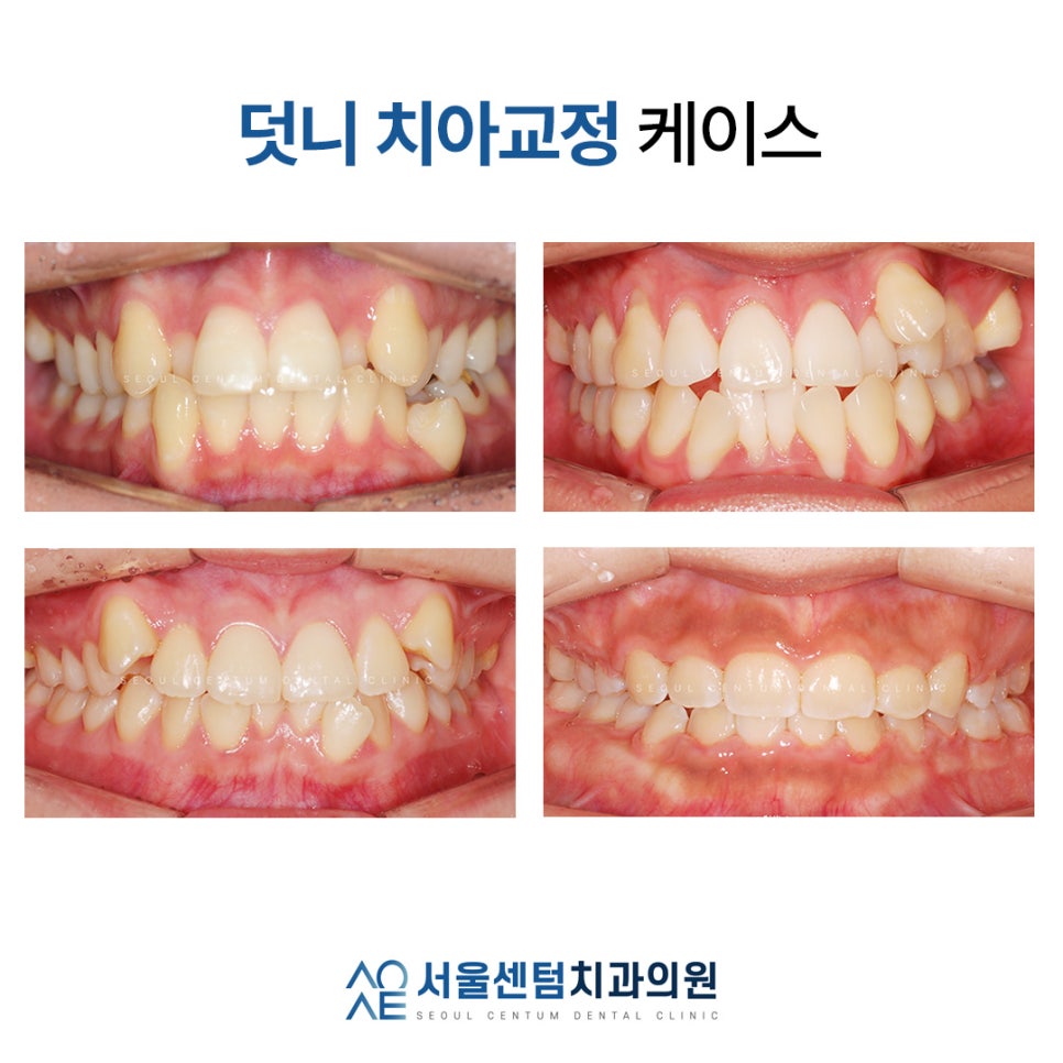 Read This Before Starting Protruding Teeth Correction image 2