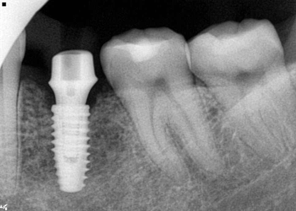 40대 임플란트 치료 케이스 상악동거상술 골이식까지 관련 이미지 11