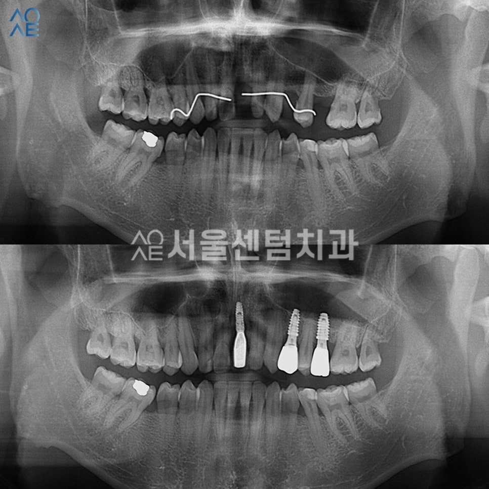 앞니 임플란트기간 실제 수술사례로 알려드려요 관련 이미지 6