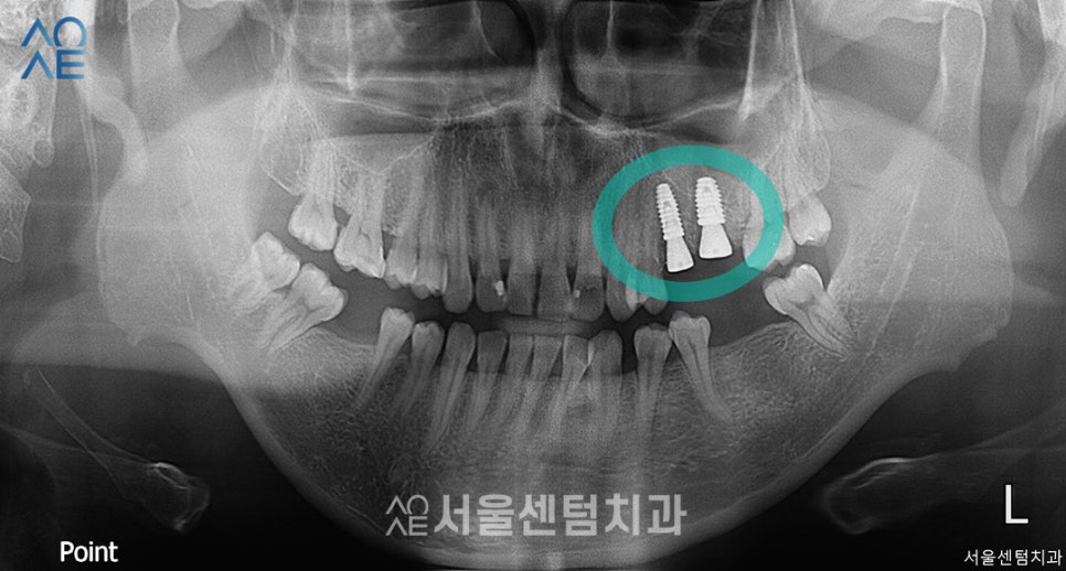 상악동수술 동반한 임플란트 진행한 이야기 관련 이미지 3
