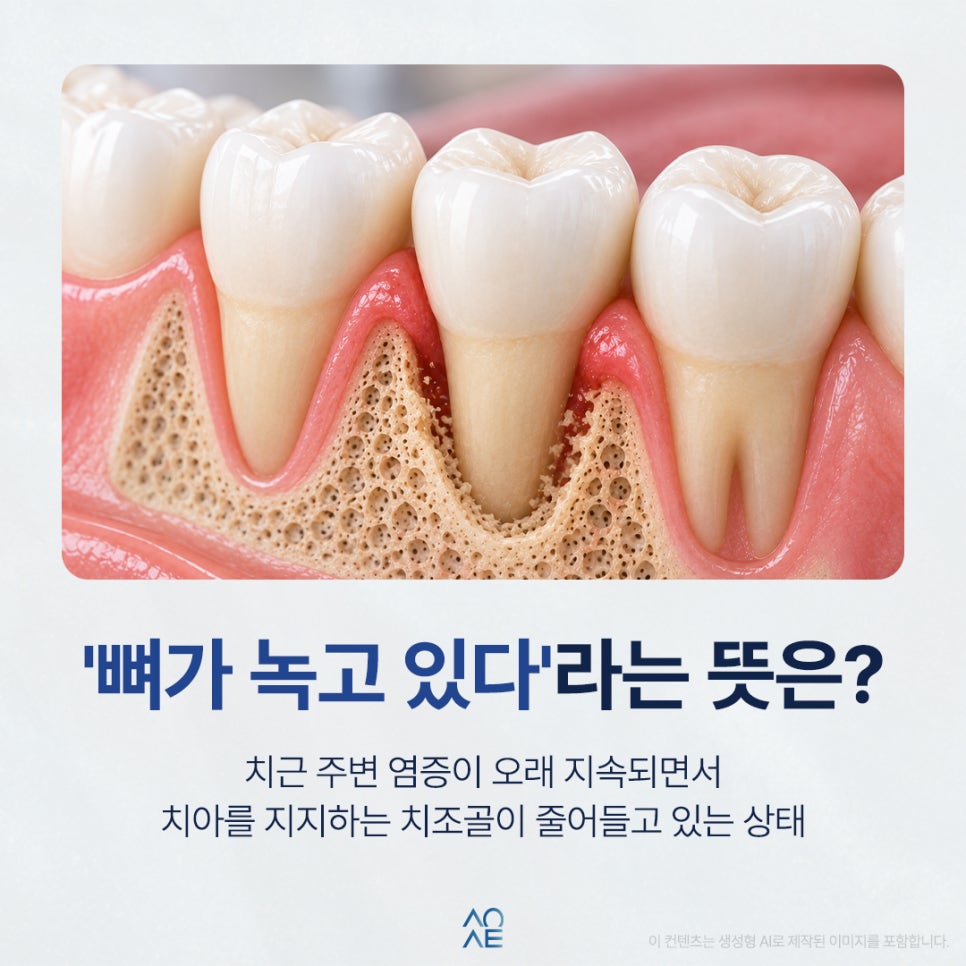 임플란트 발치 언제가 좋을까요 뼈가 녹고 있다면 빨리해야 돼요? 관련 이미지 3
