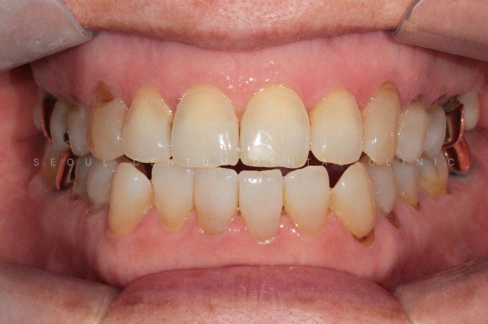 치경부마모증 가격 gi 레진 갈색치아 원인 통증 관련 이미지 7