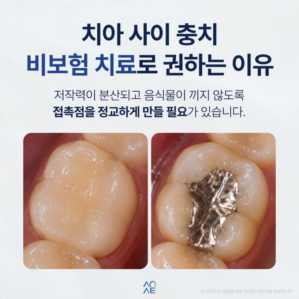 I Thought Cavity Treatment Could Use an Insurance-Covered Material—Why Is a Non-Covered Material Recommended? image 3