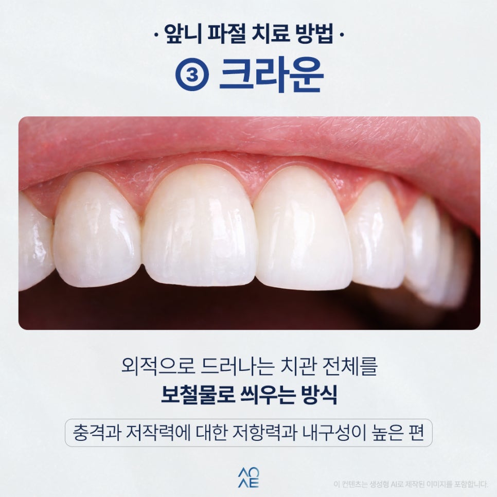 3 Treatment Options and a Cost Comparison for a Chipped Front Tooth image 5