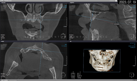 전체임플란트 기간 예상보다 줄어들 수 있는 방법과 증례 공개 관련 이미지 5