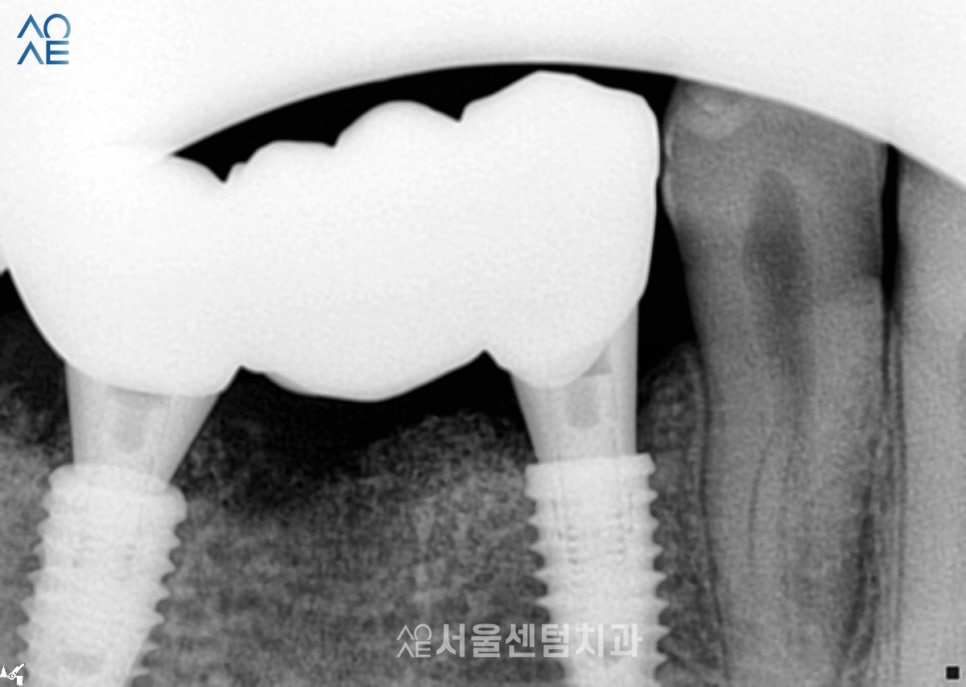 20대임플란트 처음이라 두렵다면 관련 이미지 4