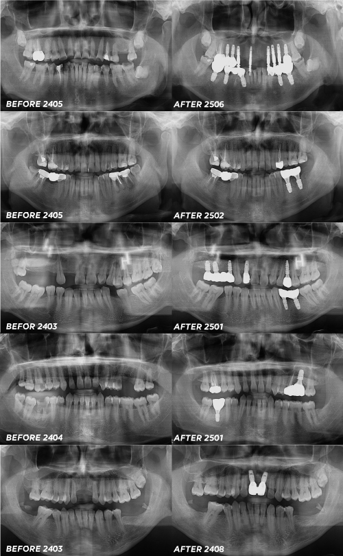 네오임플란트 뼈이식 꼭 해야할까?종류 장점 단점 관련 이미지 7