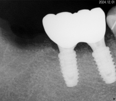 돌출입 및 신경치료와 임플란트 식립 동시 진행 증례 관련 이미지 23