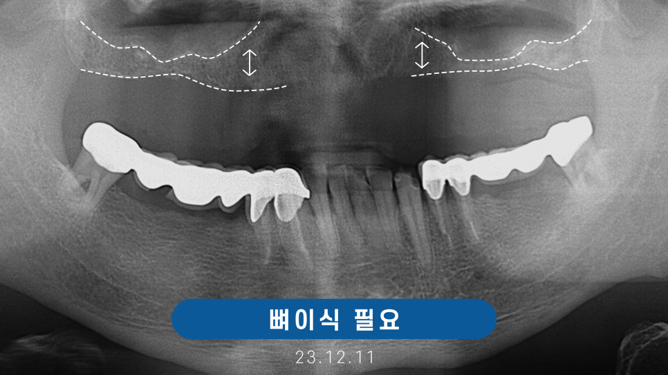 전체임플란트 노인틀니 보험 실비 비용 관련 이미지 5