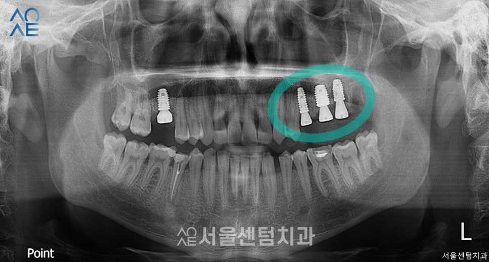 20대임플란트후기 진행과정부터 상세히 관련 이미지 3