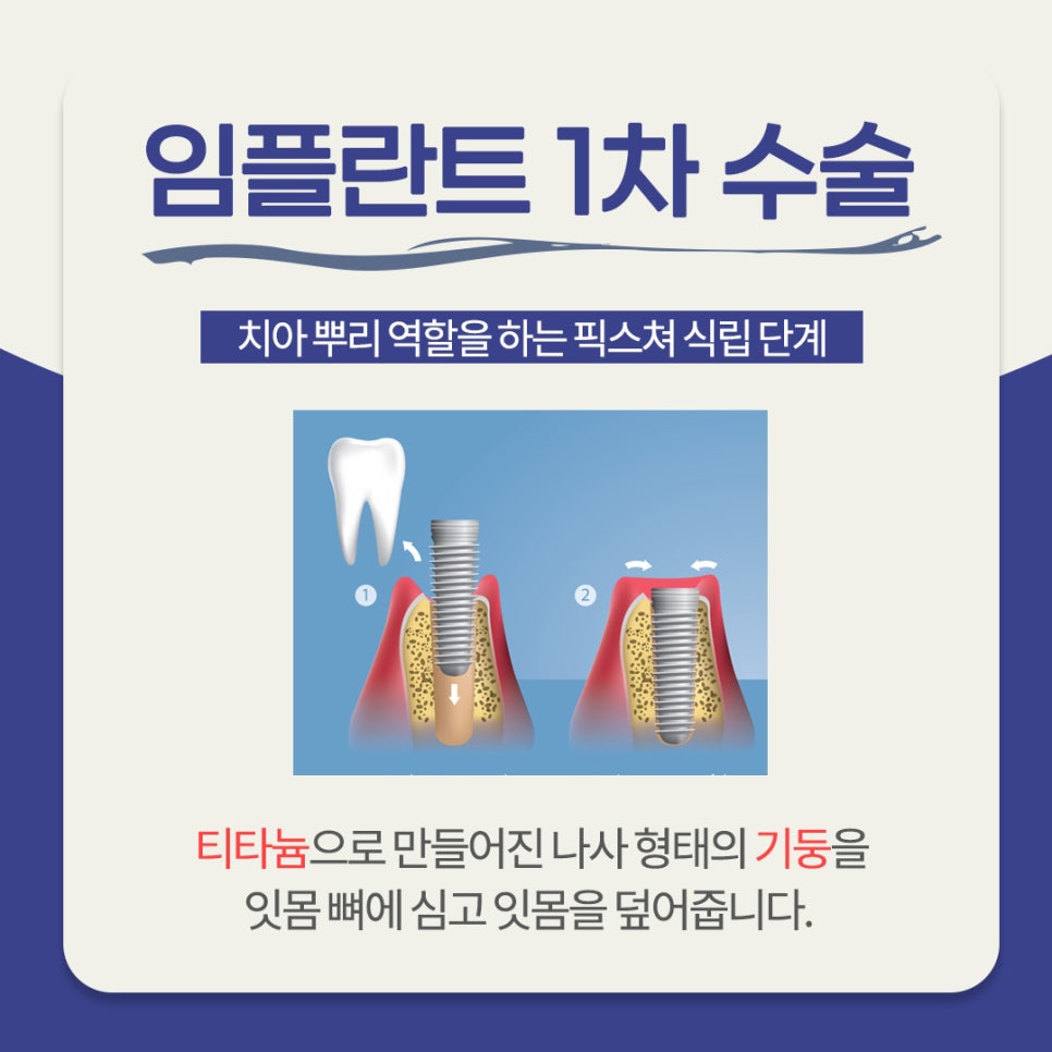 임플란트 시술과정 총 몇번 치과에 가야할까? 관련 이미지 3