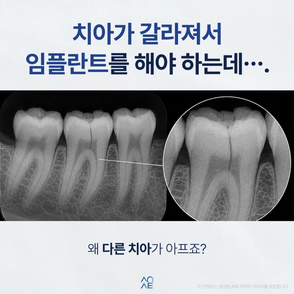 Can Pain Be Felt in Front of a Cracked Molar? A Different Tooth Is Hurting image 2