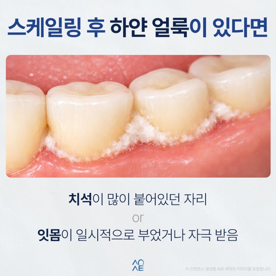 스케일링 후 보니까 치아에 하얀 얼룩인지 치석 같은 게 껴있어요 관련 이미지 2