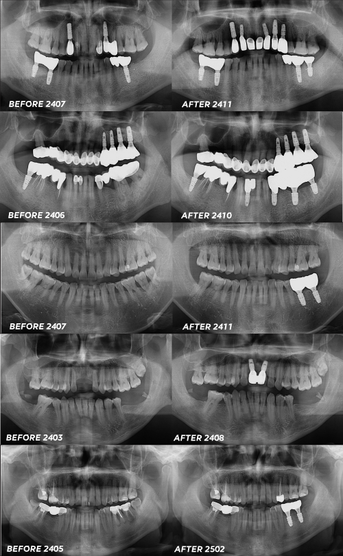 임플란트 붓기 정상인지 애매모호하다면 관련 이미지 8