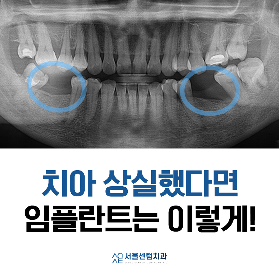 치아상실 후 임플란트 하려면 관련 이미지 6