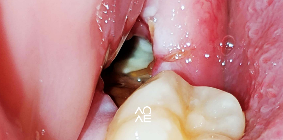 드라이소켓 건성치조와 증상 치료에 대해 관련 이미지 3