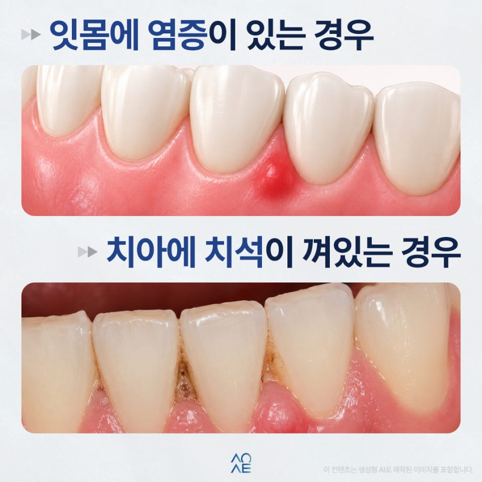 What Could Be Causing an Itchy Feeling in the Gums? Could It Be Gum Disease? image 2