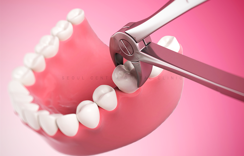 임플란트잘하는곳 해당되면 이러한 이유 때문일지도 모릅니다. 관련 이미지 5