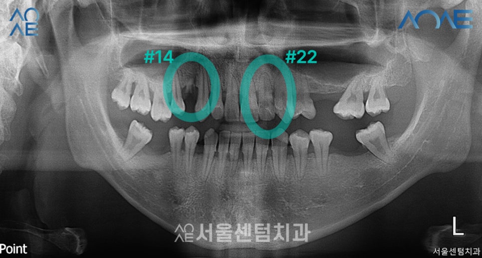 Here’s How a Korean-Made Implant Is Actually Placed image 1