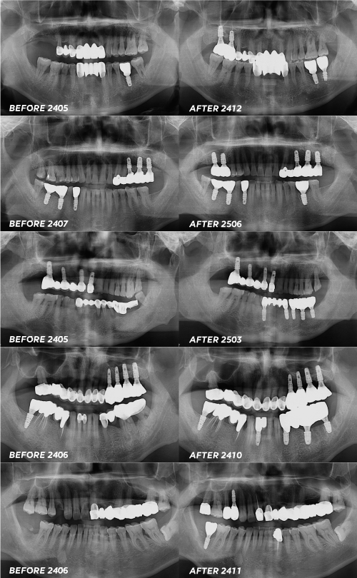 임플란트 치실 이 시기부터 이렇게 사용하세요 관련 이미지 6