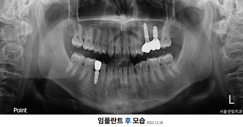 임플란트2차수술과정 언제 필요한지 핵심만 짚어보기 관련 이미지 2
